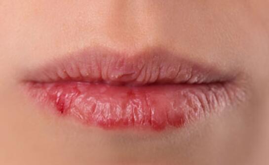 唇炎的症状是什么?