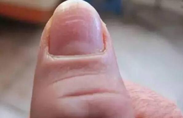 指甲太薄了怎么办？