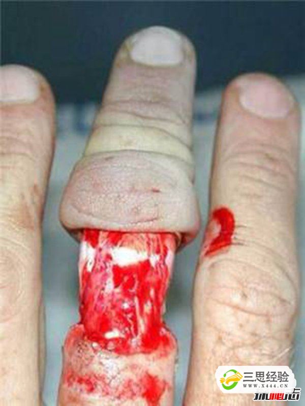 打保龄球戴戒指,手指上的肉会被活生生的剥落(图2)