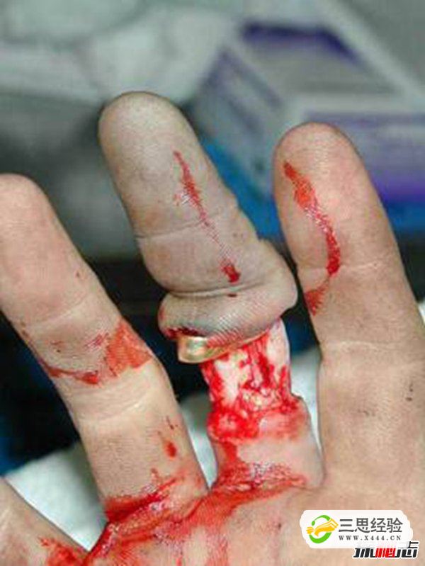 打保龄球戴戒指,手指上的肉会被活生生的剥落(图1)