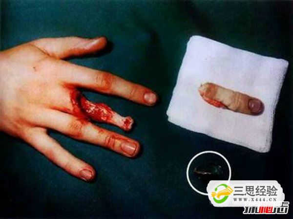 打保龄球戴戒指,手指上的肉会被活生生的剥落(图3)